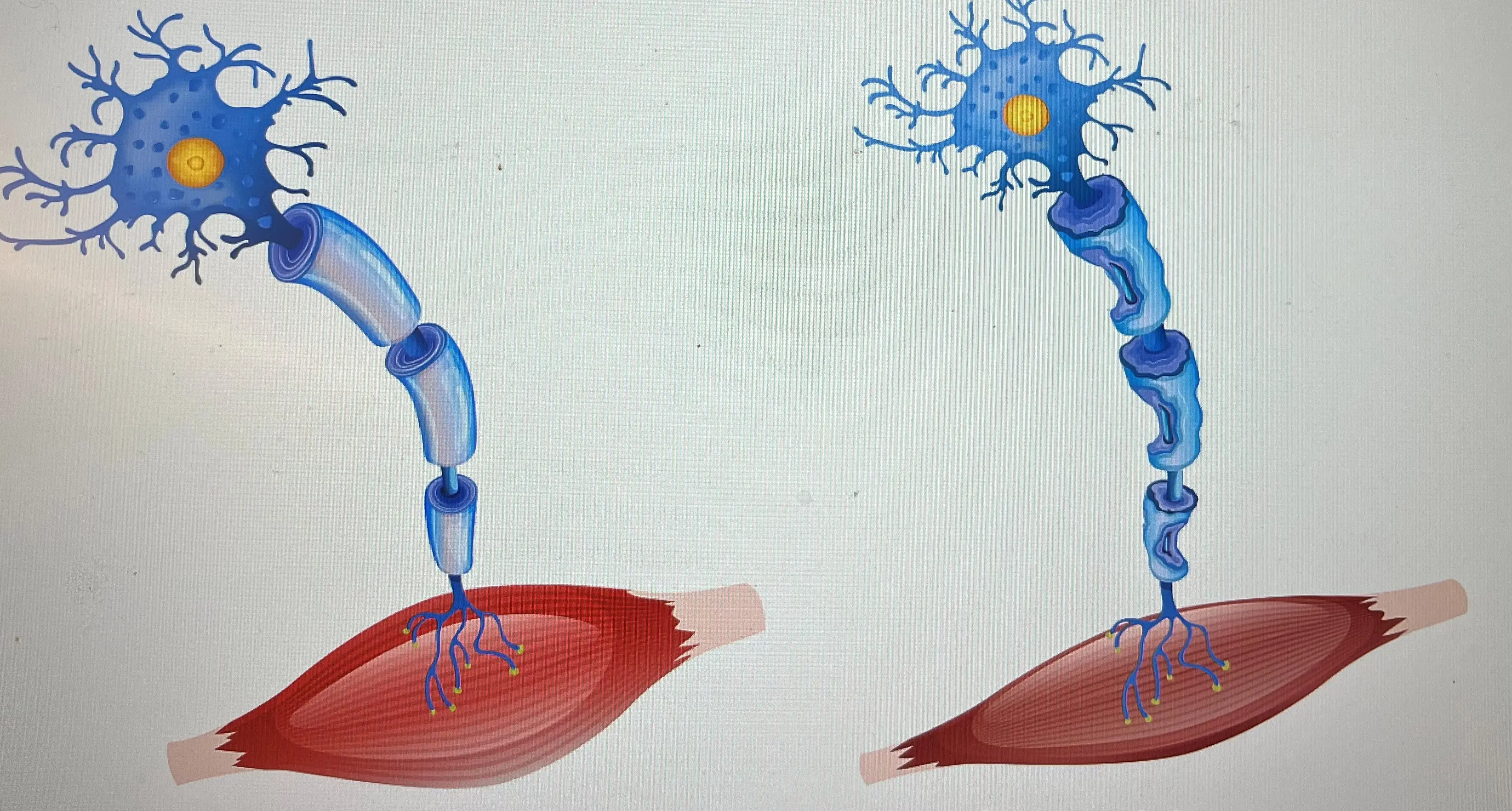 Motor neuron diseases – ALS, symptoms & therapy I PMC