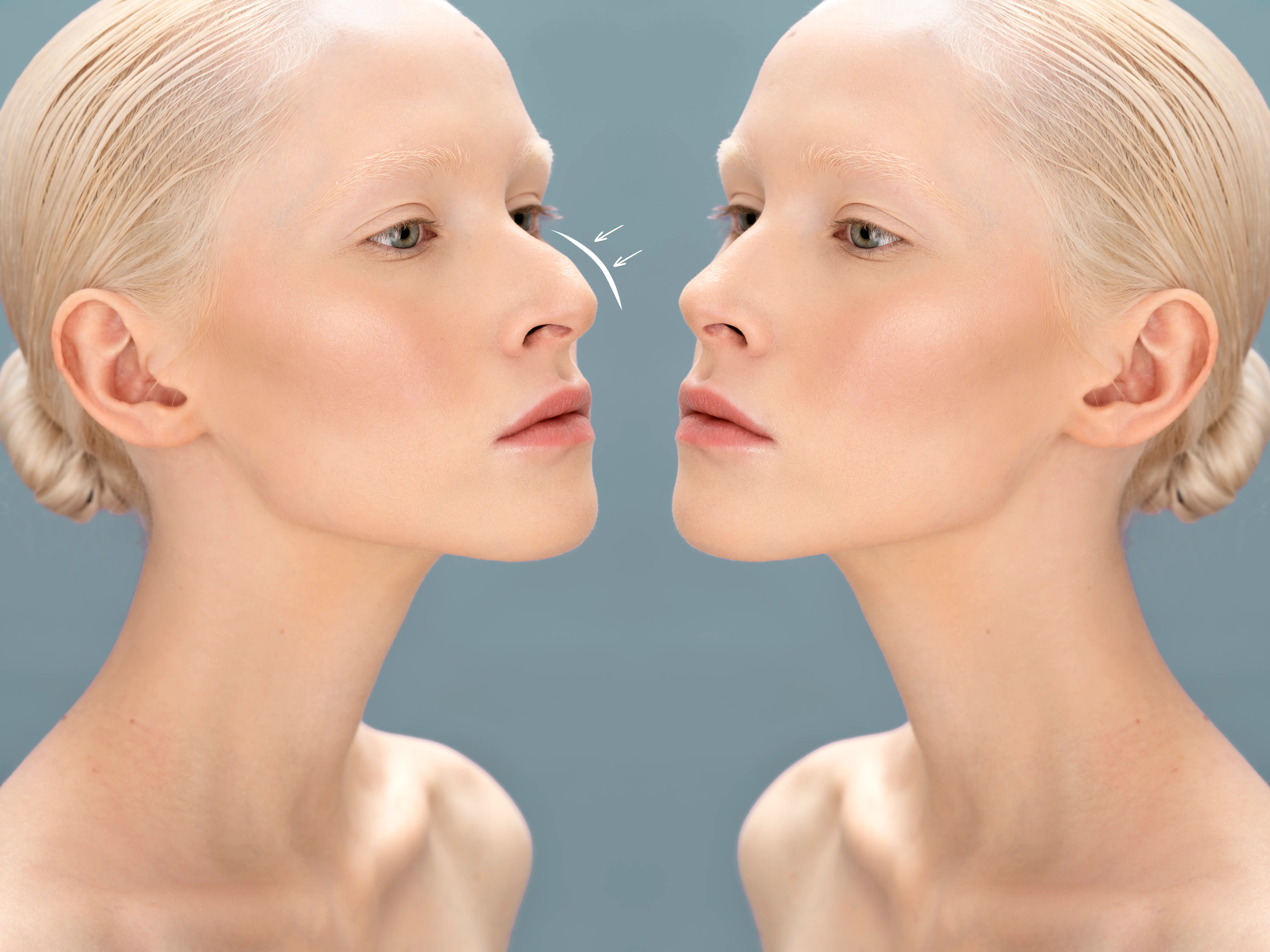 AI in Rhinoplasty: A Double-Edged Sword